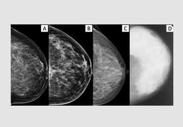 Mammographic density and inter-observer variability of pathologic evaluation of core biopsies among women with mammographic abnormalities
